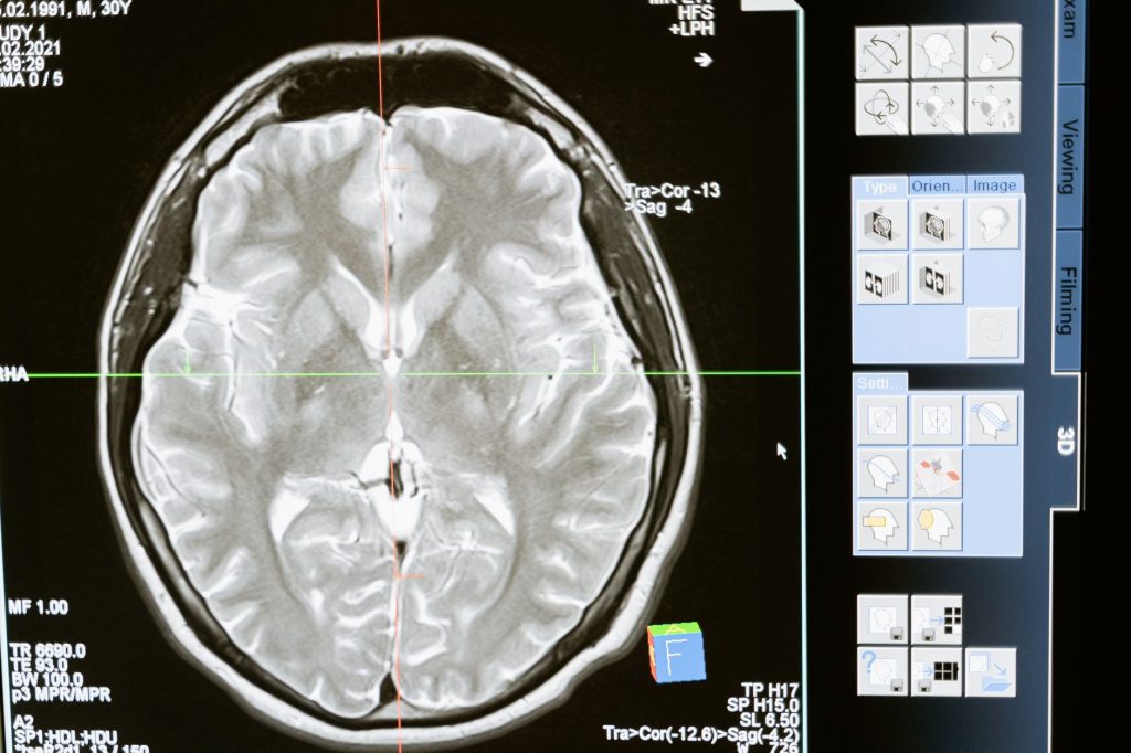 Imagerie cérébrale illustrant le remodelage du cerveau maternel pendant la grossesse